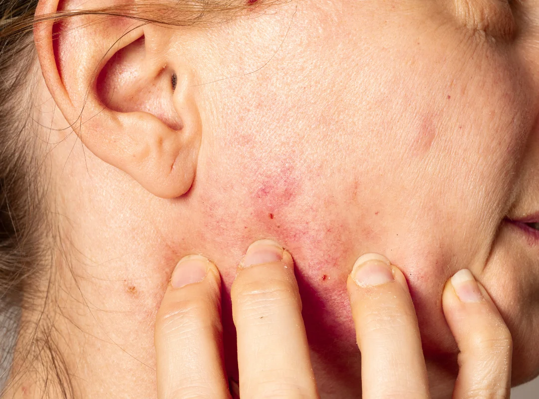 What Virus Makes Your Skin Sensitive to Touch