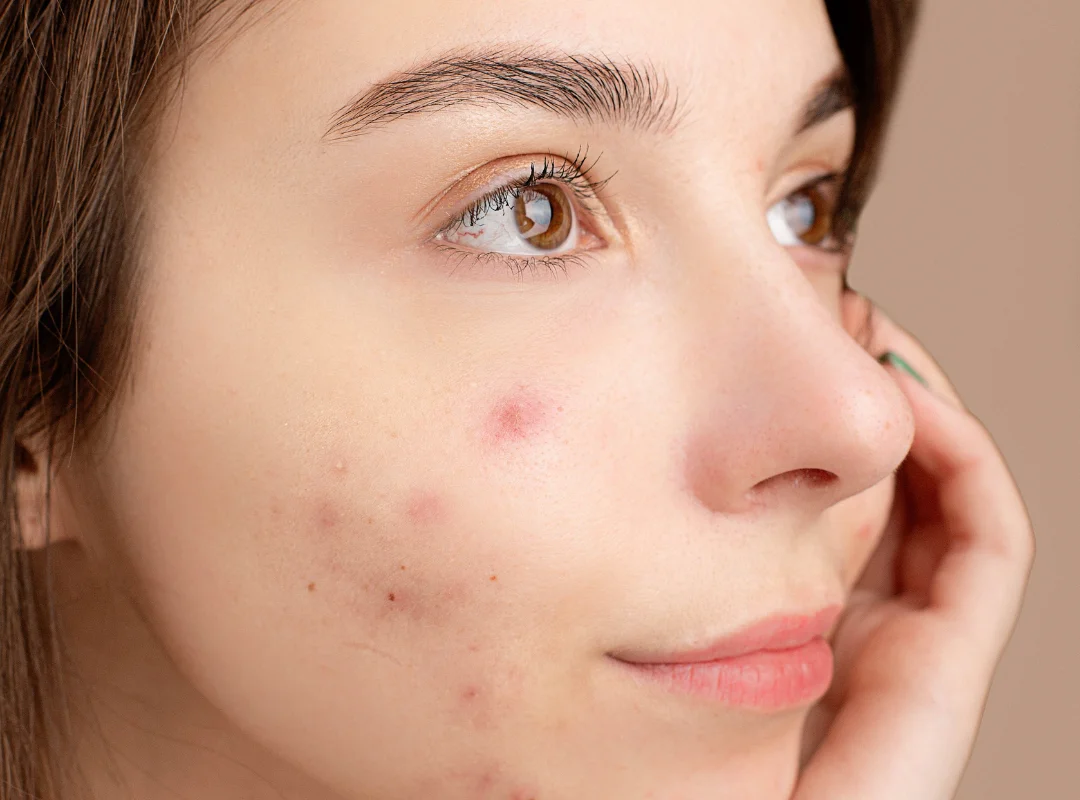 Can a Migraine Make Your Scalp Hurt