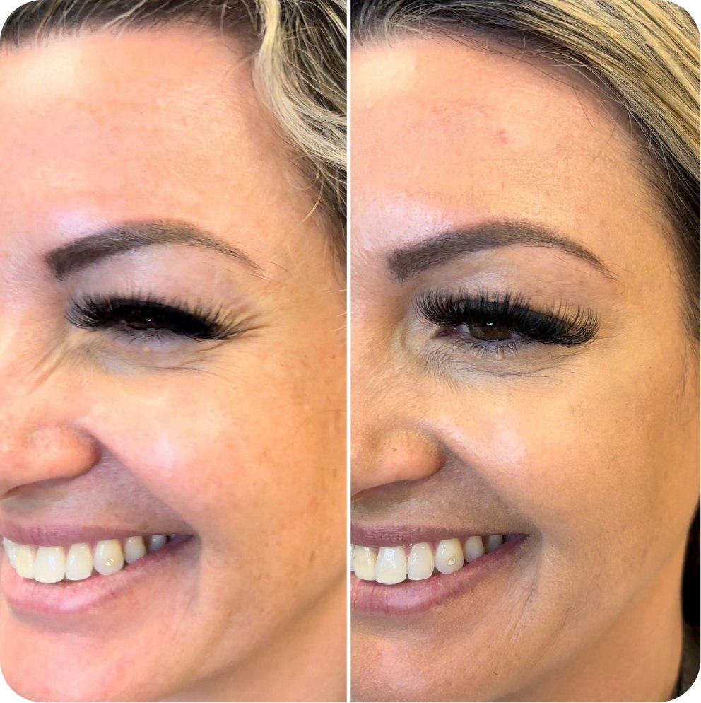 Bunny lines before and after Botox at Skin Artistry Clinic