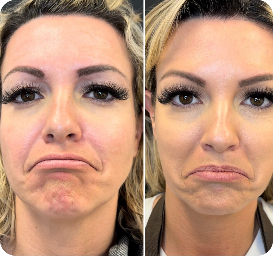 Dimpled chin before and after Botox at Skin Artistry Clinic