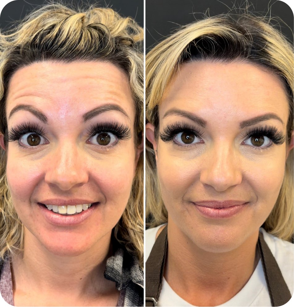 Forehead lines before and after Botox at Skin Artistry Clinic