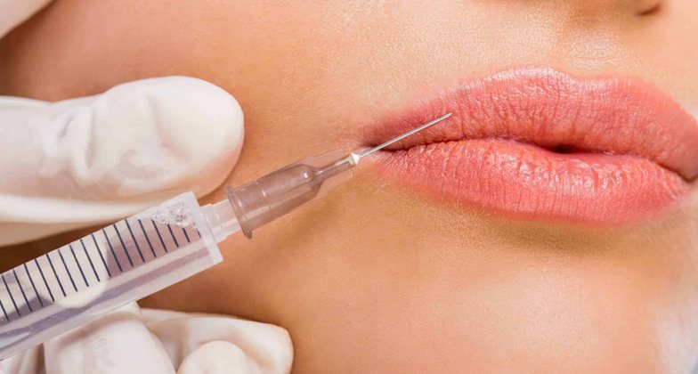 Lip Flip Botox treatment